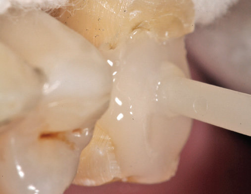 Bild einer Zahnaufbaues mit Pulpdent restorative