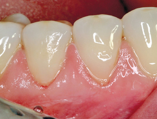 6B Ergebnis nach Reparatur sensibler zervikaler Läsionen am Zahn mit ACTIVA Material