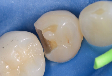 ACTIVA PRESTO als Ersatz fuer frakturierte Zahnrandrestauration 2