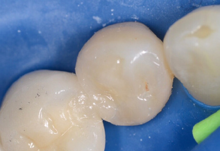 ACTIVA PRESTO als Ersatz fuer frakturierte Zahnrandrestauration 3