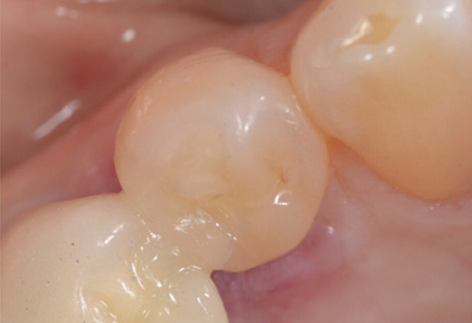 ACTIVA PRESTO als Ersatz fuer frakturierte Zahnrandrestauration 4