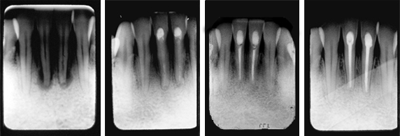 Abszedierte Zähne Röntgenbilder 1-4