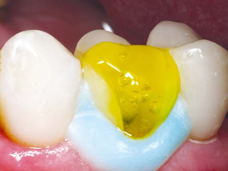 Porcelain Etch Gel KeramikÄtzgel Überblick PULPDENT