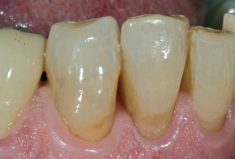 ACTIVA PRESTO unsichtbare ästhetische Zahnhalsrestauration